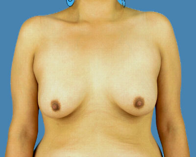 Breast Augmentation Before & After Patient #1178