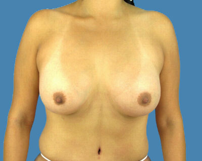 Breast Augmentation Before & After Patient #1178