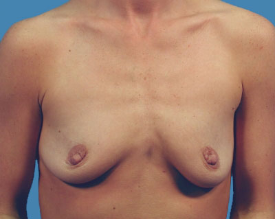 Breast Augmentation Before & After Patient #1095