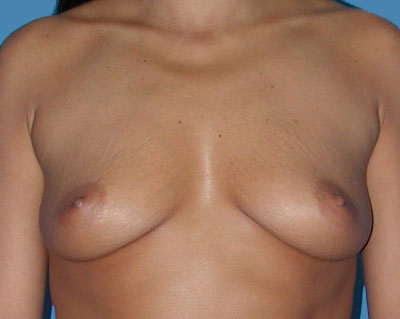 Breast Augmentation Before & After Patient #1099