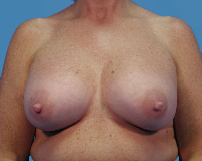 Breast Augmentation Before & After Patient #1101