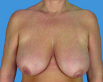 Breast Lift Before & After Patient #899