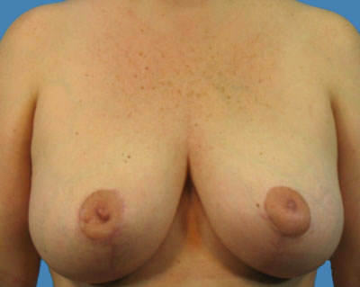 Breast Lift Before & After Patient #958