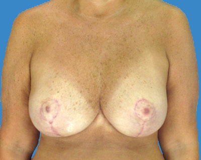 Breast Lift Before & After Patient #972
