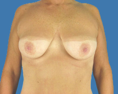 Breast Lift Before & After Patient #980