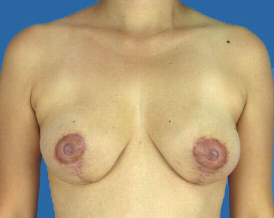 Breast Lift Before & After Patient #983