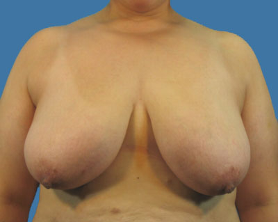 Breast Lift Before & After Patient #997