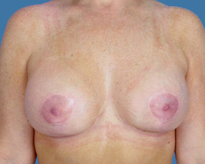 Breast Lift Before & After Patient #998