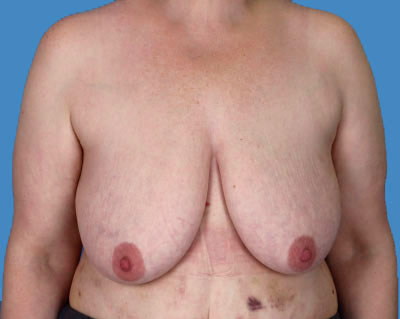Breast Lift Before & After Patient #918