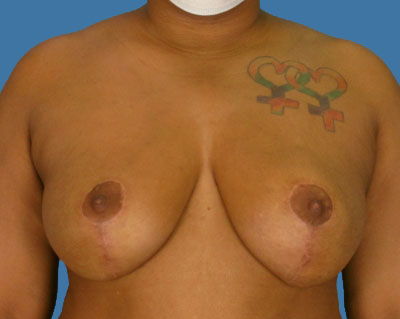 Breast Lift Before & After Patient #1000
