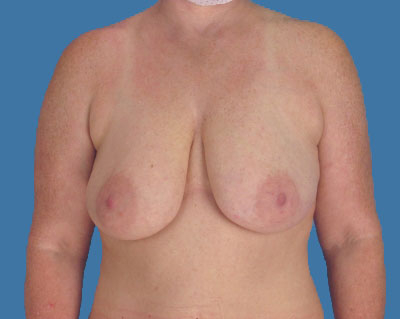 Breast Lift Before & After Patient #1010