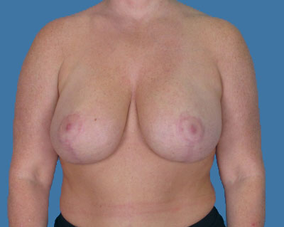 Breast Lift Before & After Patient #1010
