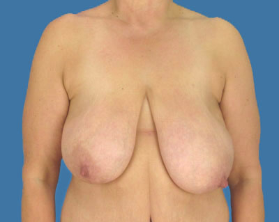 Breast Lift Before & After Patient #931