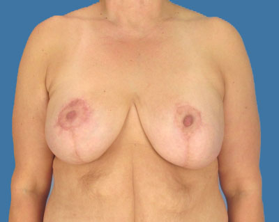Breast Lift Before & After Patient #931