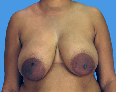 Breast Lift Before & After Patient #938