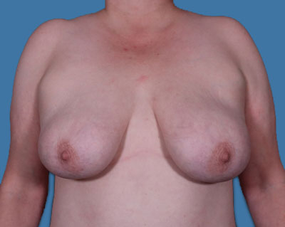 Breast Lift Before & After Patient #940