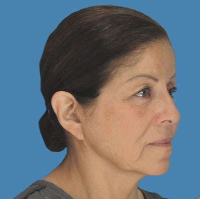 Facelift Before & After Patient #905