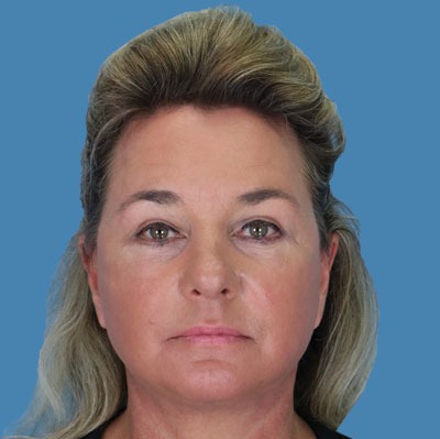 Facelift Before & After Patient #906