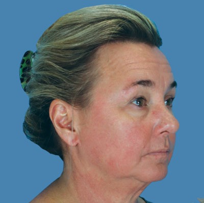 Facelift Before & After Patient #902