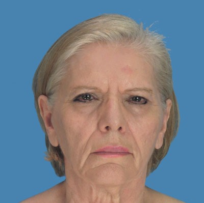 Facelift Before & After Patient #903