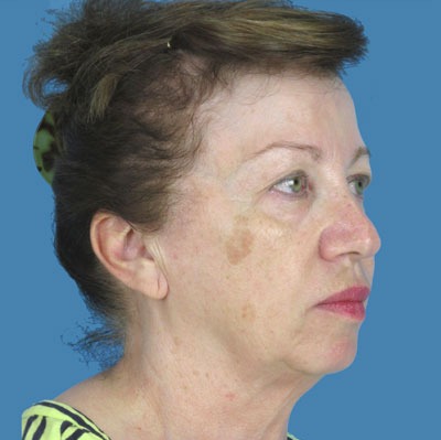 Facelift Before & After Patient #933