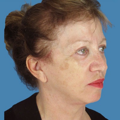 Facelift Before & After Patient #933