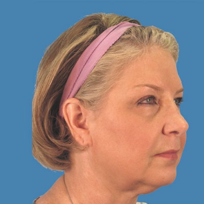 Facelift Before & After Patient #934