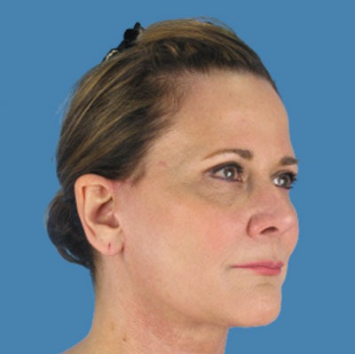 Facelift Before & After Patient #935