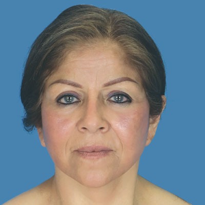 Facelift Before & After Patient #936
