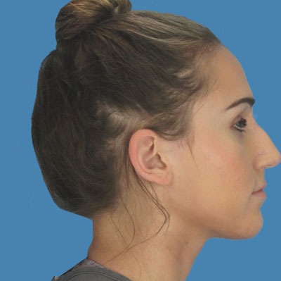 Rhinoplasty Before & After Patient #953