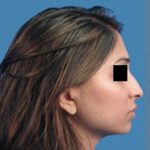 Rhinoplasty Before & After Patient #963
