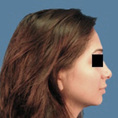 Rhinoplasty Before & After Patient #963
