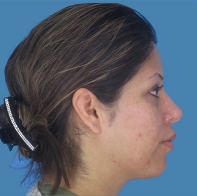 Rhinoplasty Before & After Patient #964