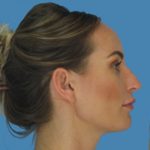 Rhinoplasty Before & After Patient #965