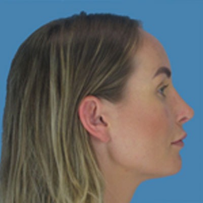 Rhinoplasty Before & After Patient #965