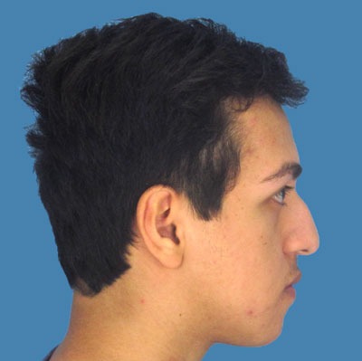 Rhinoplasty Before & After Patient #966