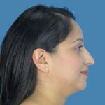 Rhinoplasty Before & After Patient #967