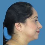 Rhinoplasty Before & After Patient #967