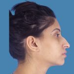 Rhinoplasty Before & After Patient #968