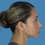 Rhinoplasty Before & After Patient #969