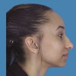 Rhinoplasty Before & After Patient #970