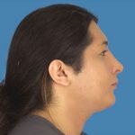 Rhinoplasty Before & After Patient #971
