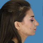 Rhinoplasty Before & After Patient #954