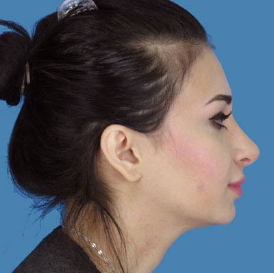 Rhinoplasty Before & After Patient #954