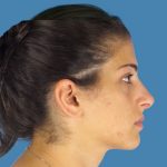 Rhinoplasty Before & After Patient #955