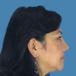Rhinoplasty Before & After Patient #960