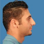 Rhinoplasty Before & After Patient #961