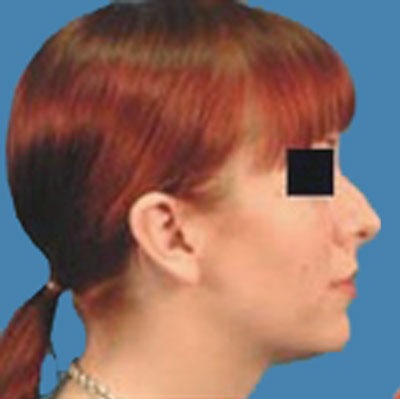 Rhinoplasty Before & After Patient #962
