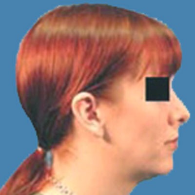 Rhinoplasty Before & After Patient #962