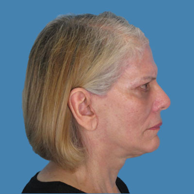Neck Lift Before & After Patient #1892